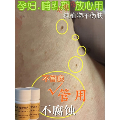 水漾花田脖子小肉粒去不腐蚀脖子上的小肉粒祛颈部小肉赘疙瘩丝状尤皮赘默认尺寸